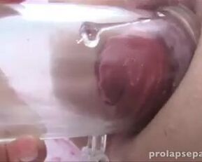 Hot kinky lesbians pump their prolapsed holes with dildos & toys
