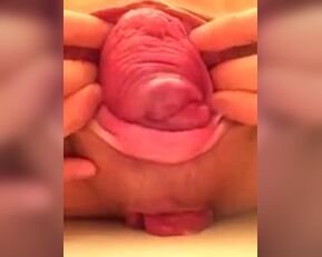 Amateur babe gets her prolapsed cervix examined up close and personal