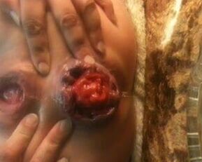 Watch this amateur babe's prolapsed butt on webcam