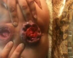 Watch this amateur babe's prolapsed butt on webcam