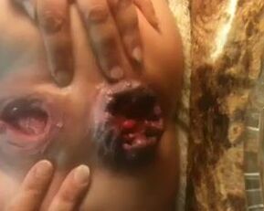 Watch this amateur babe's prolapsed butt on webcam