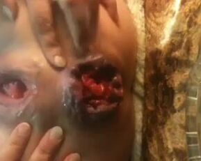 Watch this amateur babe's prolapsed butt on webcam