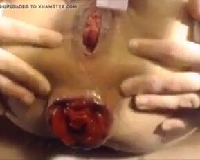 Watch how this amateur gets her prolapsed asshole wrecked with extreme insertions in stockings & panties